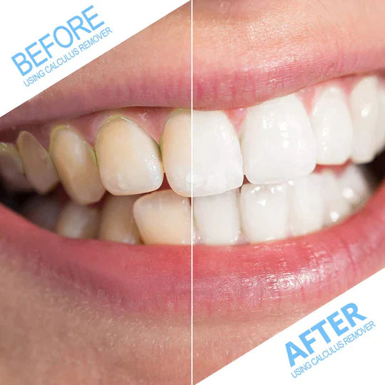 Smile Therapy - Ultrasonic Tooth Cleaner *BEST SELLER* DP8